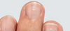 Do you have zinc spots on your finger nails?